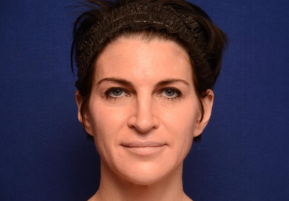 Injectable Brow Lift Before & After