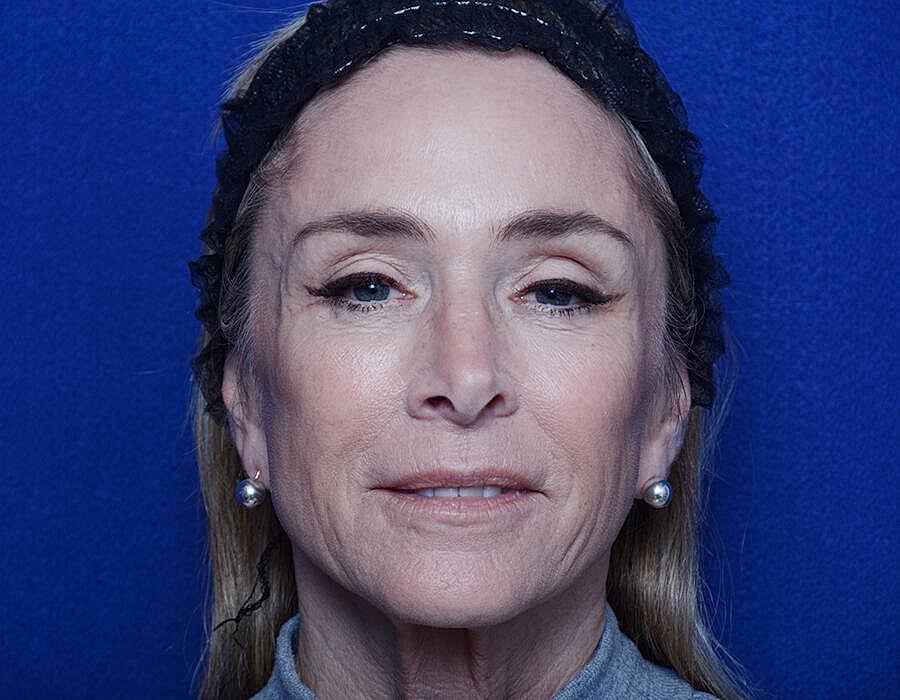 Radiesse Injections Before & After