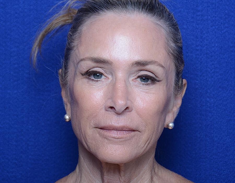 Radiesse Injections Before & After