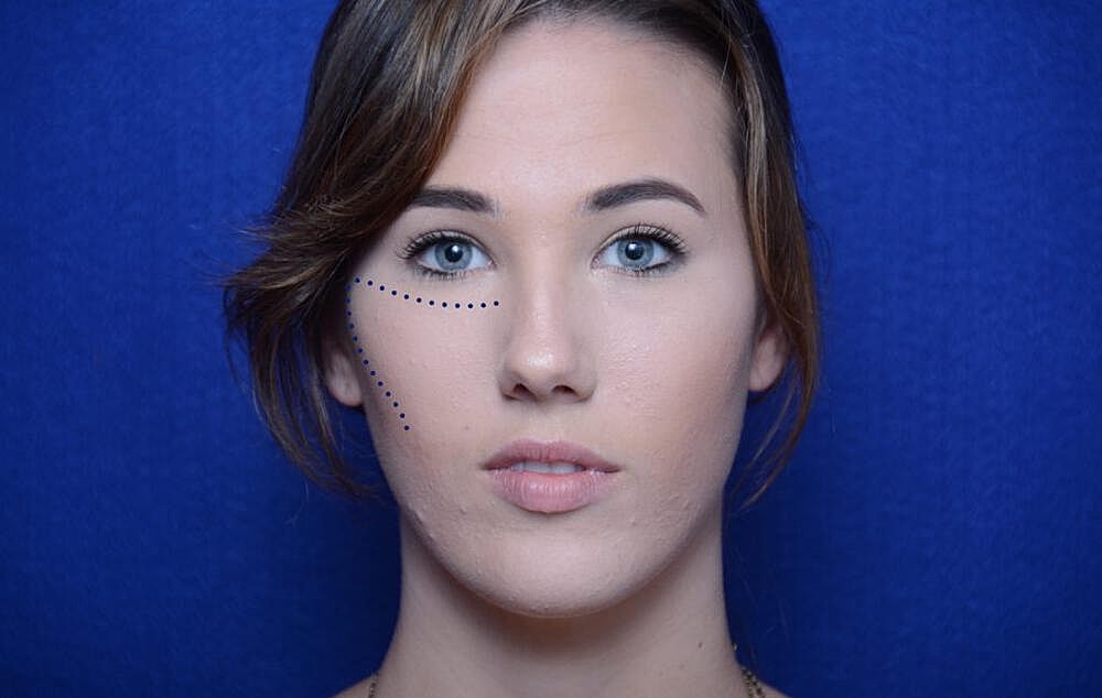 Radiesse Injections Before & After