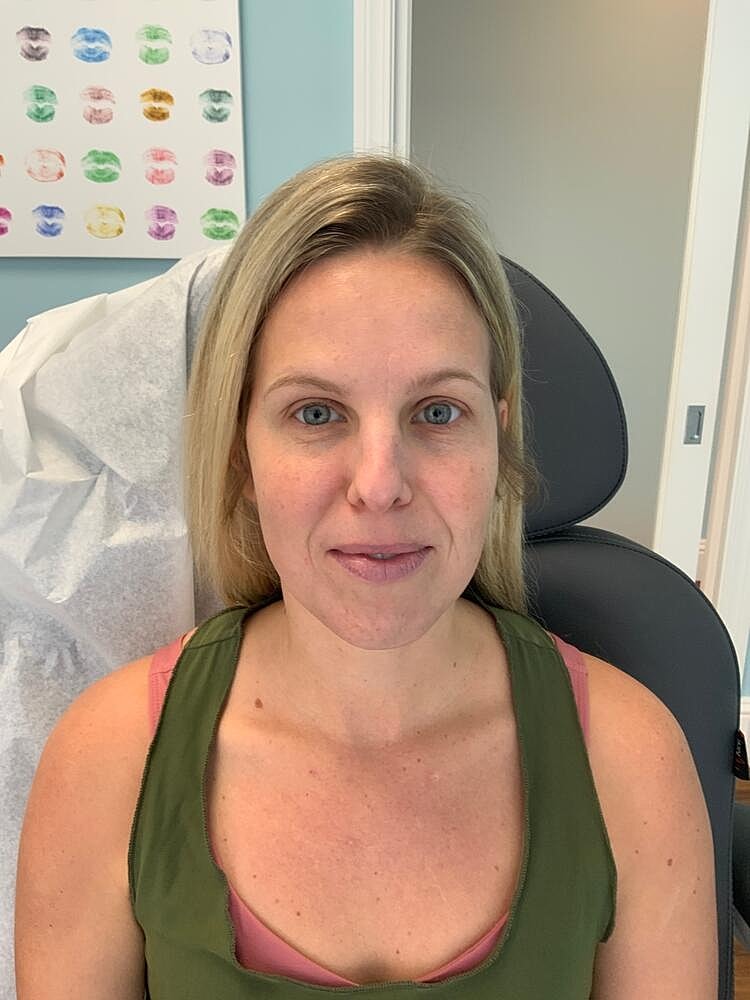 Wrinkle Reduction Before & After