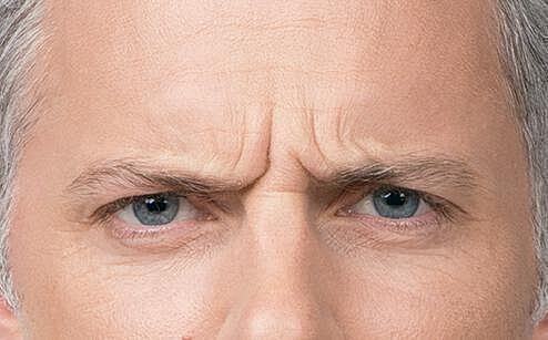 Botox Men Before & After