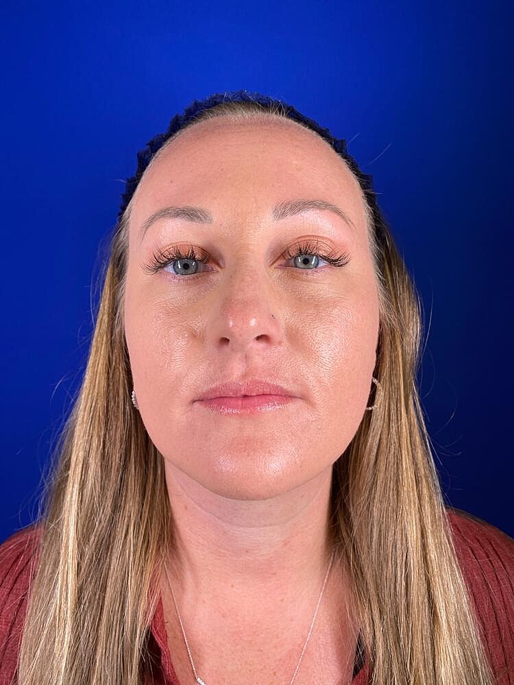 Lip Augmentation Before & After