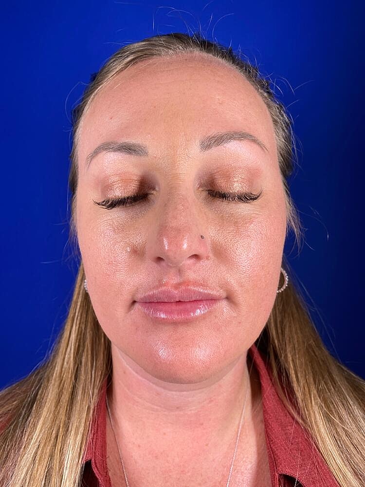 Lip Augmentation Before & After