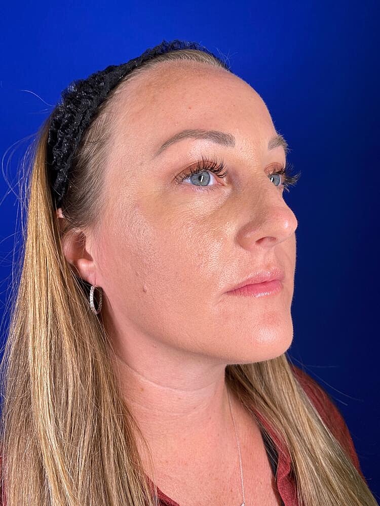 Lip Augmentation Before & After