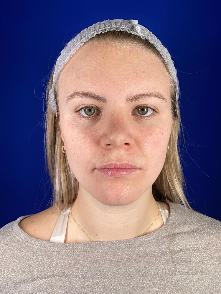 Lip Augmentation Before & After