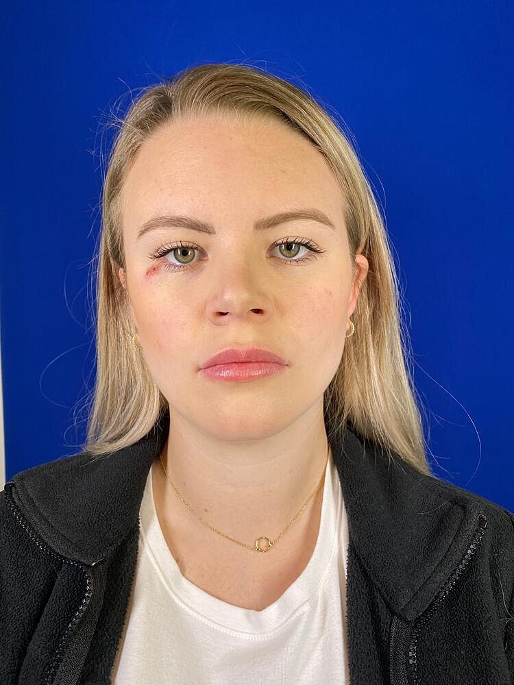 Lip Augmentation Before & After