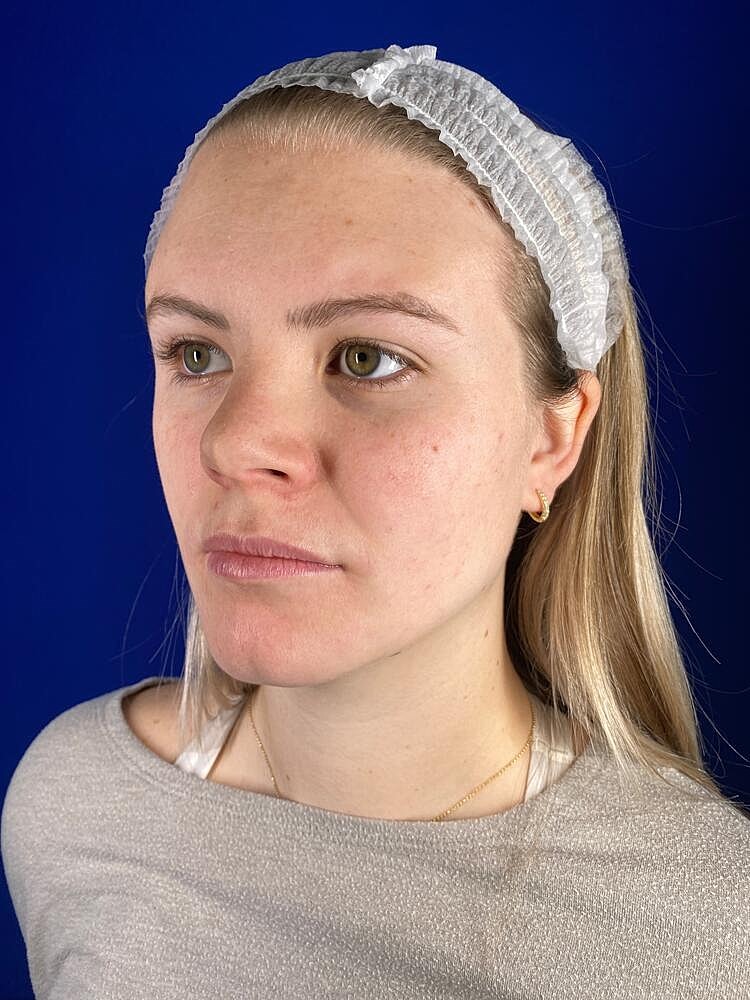 Lip Augmentation Before & After