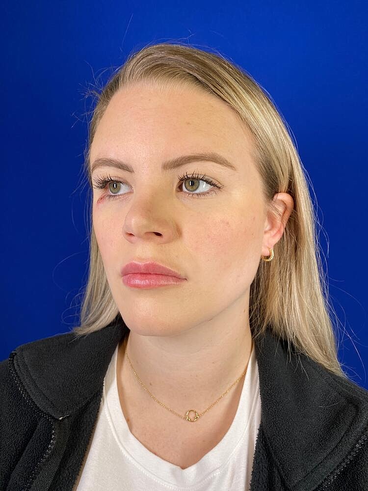 Lip Augmentation Before & After