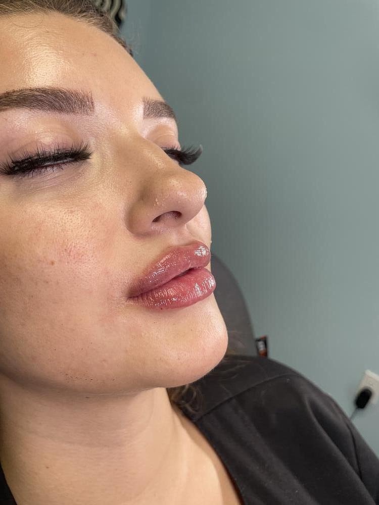 Lip Augmentation Before & After