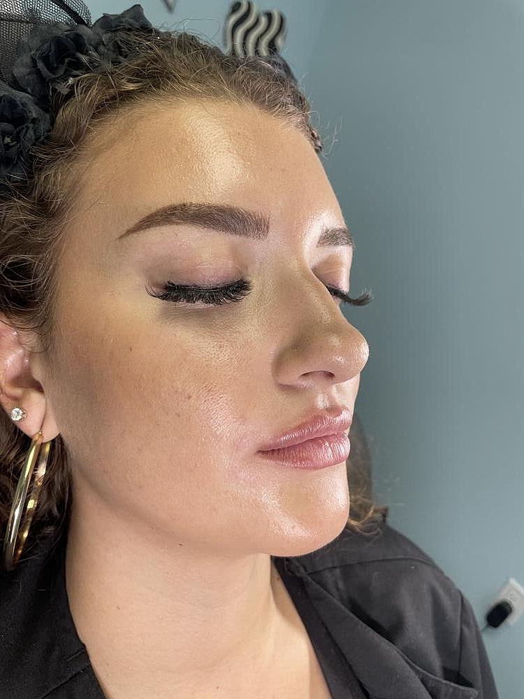 Lip Augmentation Before & After