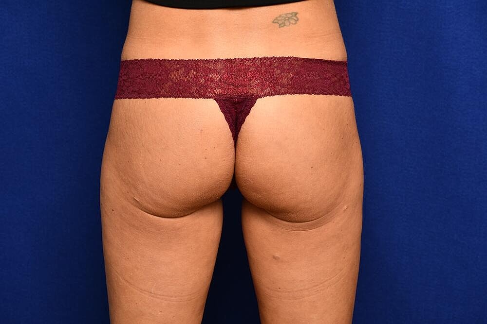 Injectable Butt Lift Before & After