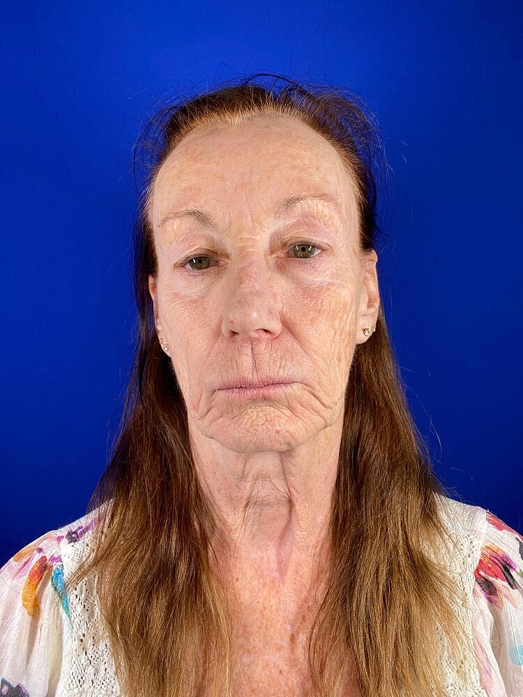 Renuva Before & After