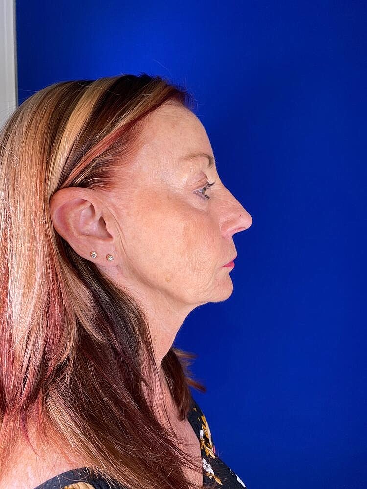 Renuva Before & After